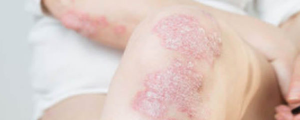 psoriasis des mains et des pieds