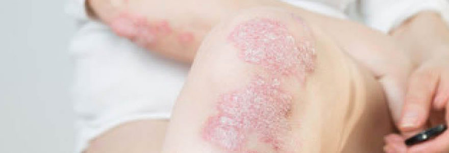 psoriasis des mains et des pieds